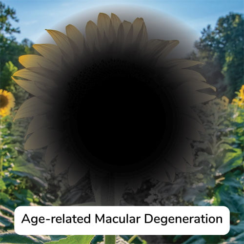 Simulation of what age-related macular degeneration looks like