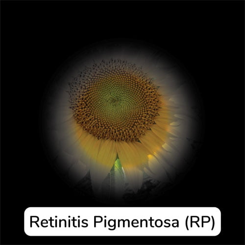 Simulation of what Retinitis Pigmentosa (RP) looks like