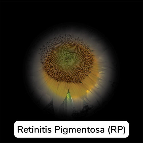 Simulation of what Retinitis Pigmentosa (RP) looks like